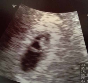 baby-US-after-reversing-tubes