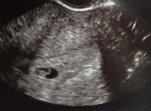 vaginal-ultrasound-tubal-reversal-pregnancy