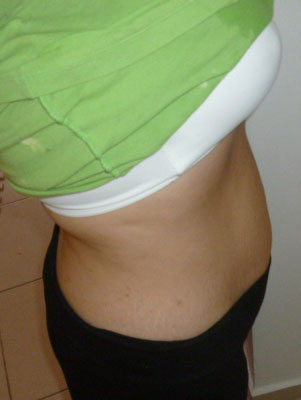 tubal after weight ligation essure gain