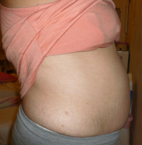 bloating-Before-Essure-removal-surgery