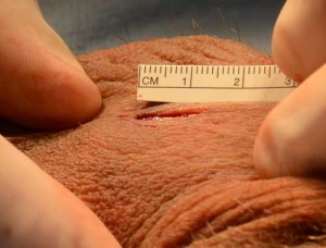 demonstration of the size on a no scalpel vasectomy reversal opening