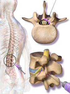 Epidural anesthesia for tubal reversal