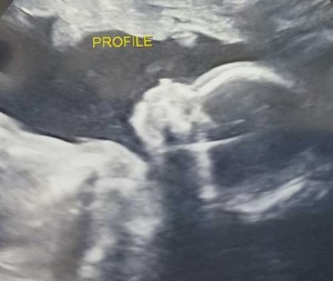 ultrasound-picture-of-second-tubal-reversal-baby