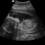 Maryland tubal reversal baby