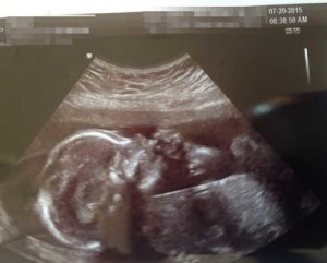 Tubal reversal baby from Moosup Connecticut