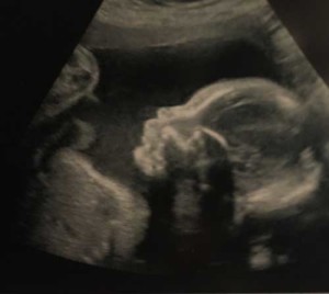 tenessee-tubal-reversal-baby