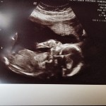 Ultrasound-of-Michigan-tubal-reversal-baby