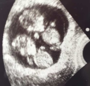 is there a chance of twins after tubal reversal surgery?