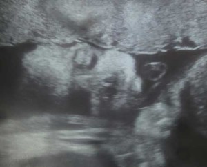 Knoxville Tennessee tubal reversal baby on the way!