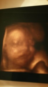 super surprised pregnant with blocked fallopian tube