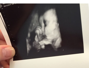 Clips-removed-from-tubes-and-woman-becomes-pregnant