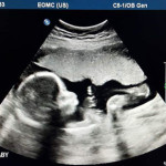 ultrasound after reversing burned tubes