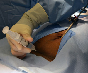laparoscopy-a-great-tubal-reversal-insurance-policy