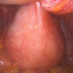 uterine-scar-tissue-diagnosed-during-tuba-reversal-surgery