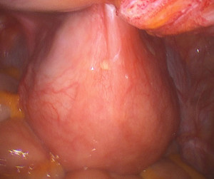 uterine-scar-tissue-diagnosed-during-tubal-reversal-surgery