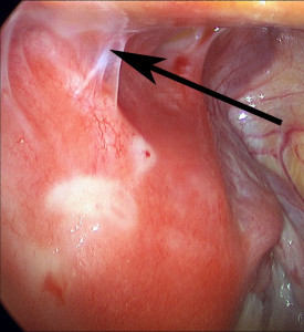 tubal-reversal-and-scar-tissue