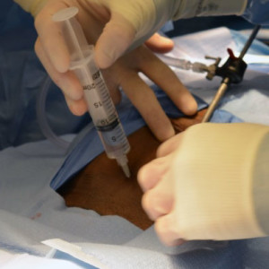 screening-laparoscopy-offers-tubal-reversal-insurance-policy