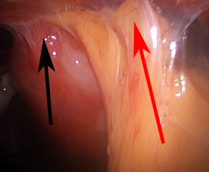 Black arrow demonstrates uterus adherent to muscles. Red arrow demonstrates intestines adherent to muscles