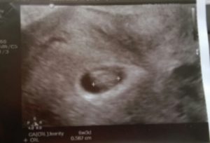 Essure reversal pregnancy after endometrial ablation