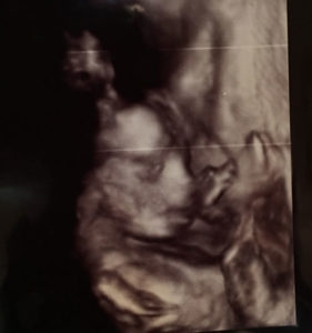 Pennsylvania-reversal-pregnancy-update