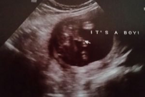 alabama tubal reversal