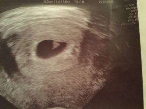 IVF-tubal-reversal-patients-travel-from-Europe-to-have-reversal-surgery