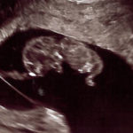 MO-tubal-reversal-baby-at-10-weeks-gestation