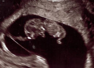 MO-tubal-reversal-baby-at-10-weeks-gestation