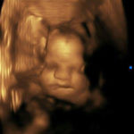 second-Essure-reversal-baby-at-30-weeks-gestation