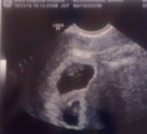 tubal reversal twins from Bradford ME
