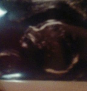 age-43-and-pregnant-after-reversal-surgery