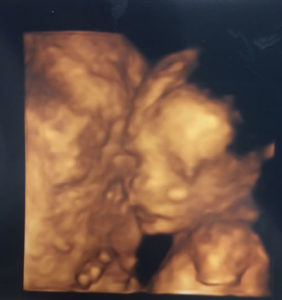 worth-travel-from-Michigan-for-tubal-reversal-surgery