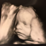 Essure-reversal-baby-on-ultrasound