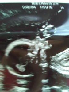 second-tubal-reversal-mom-age-41