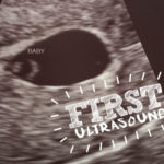 first-essure-reversal-baby-ultrasound-photo