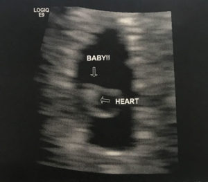 succesful-essure-reversal-baby-from-Iowa