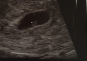 6-weeks-pregnant-after-tubal-reversal