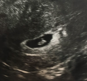 excited-to-be-pregnant-after-tuba-reversal 