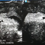 new-zealand-tubal-reversal-triplets