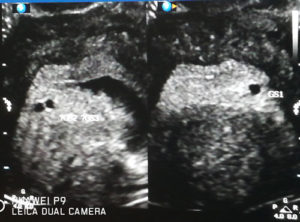 new-zealand-tubal-reversal-triplets