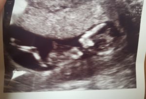 12-weeks-pregnant-after-tubal-reversal