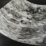 nc-tubal-reversal-baby-in-the-right-place