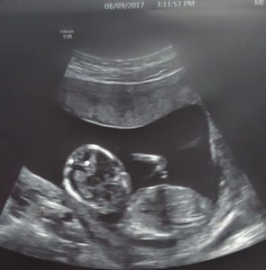 19-weeks-with-tubal-reversal-baby-girl