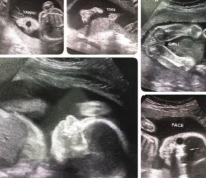 Essure-reversal-baby-is-growing