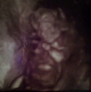 13-weeks-pregnant-happy-tubal-reversal