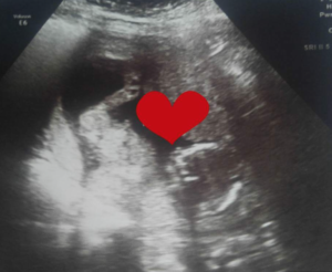 ultrasound-of-indiana-tubal-reversal-baby