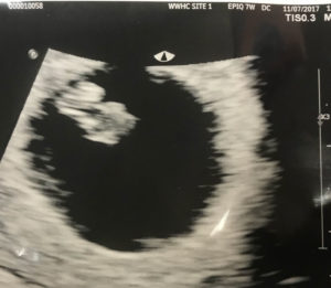 age-44-and-pregnant-after-tubal-reversal-surgery