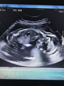 having-a-baby-boy-after-reversing-tuba-clips