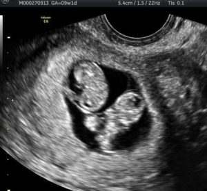 identical-twins-after-reversing-burned-tubal-ligation