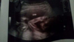 specialized-tubal-repair-one-tube-open